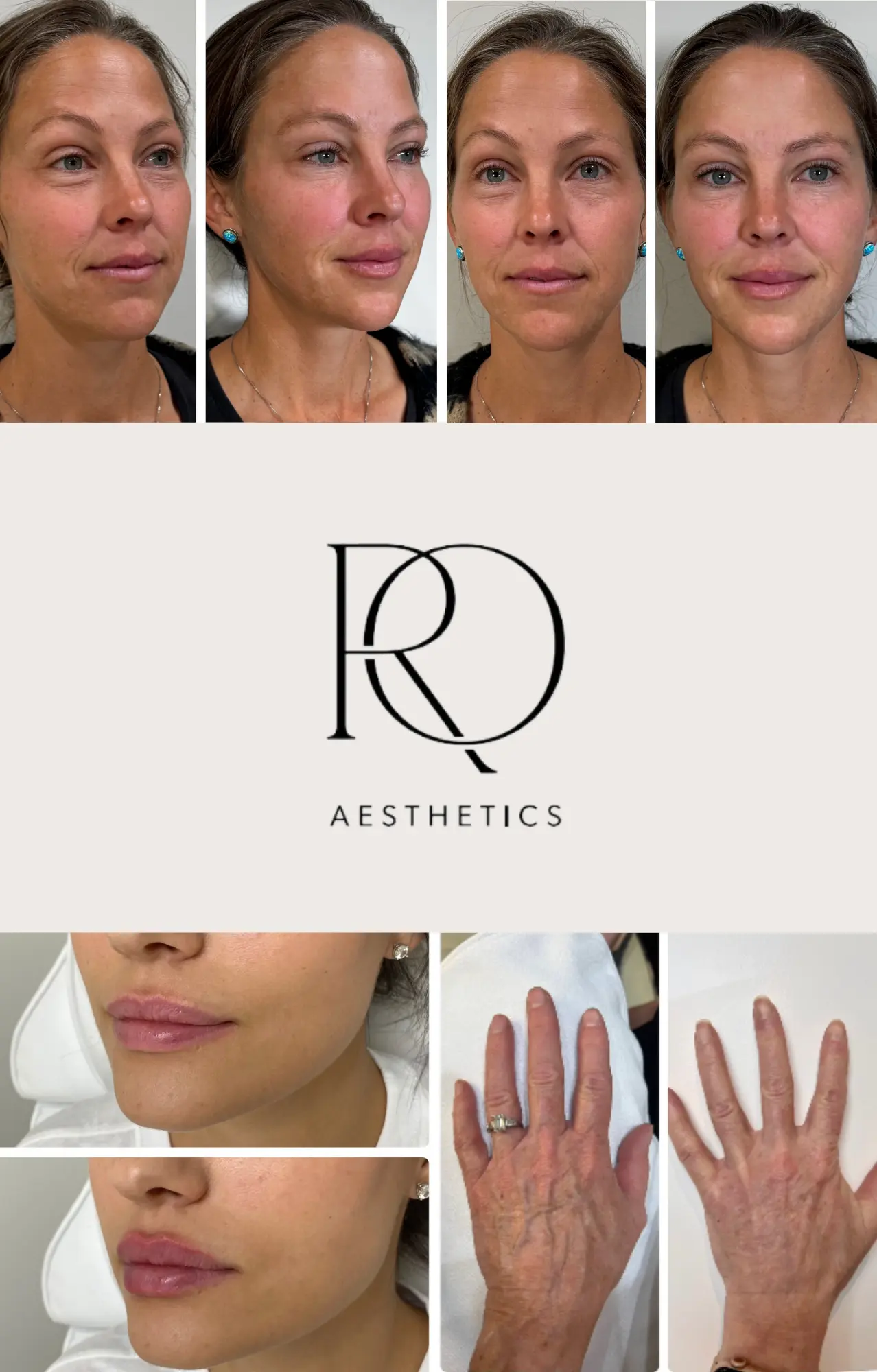 Before and after results of aesthetic treatments at RO Aesthetics.