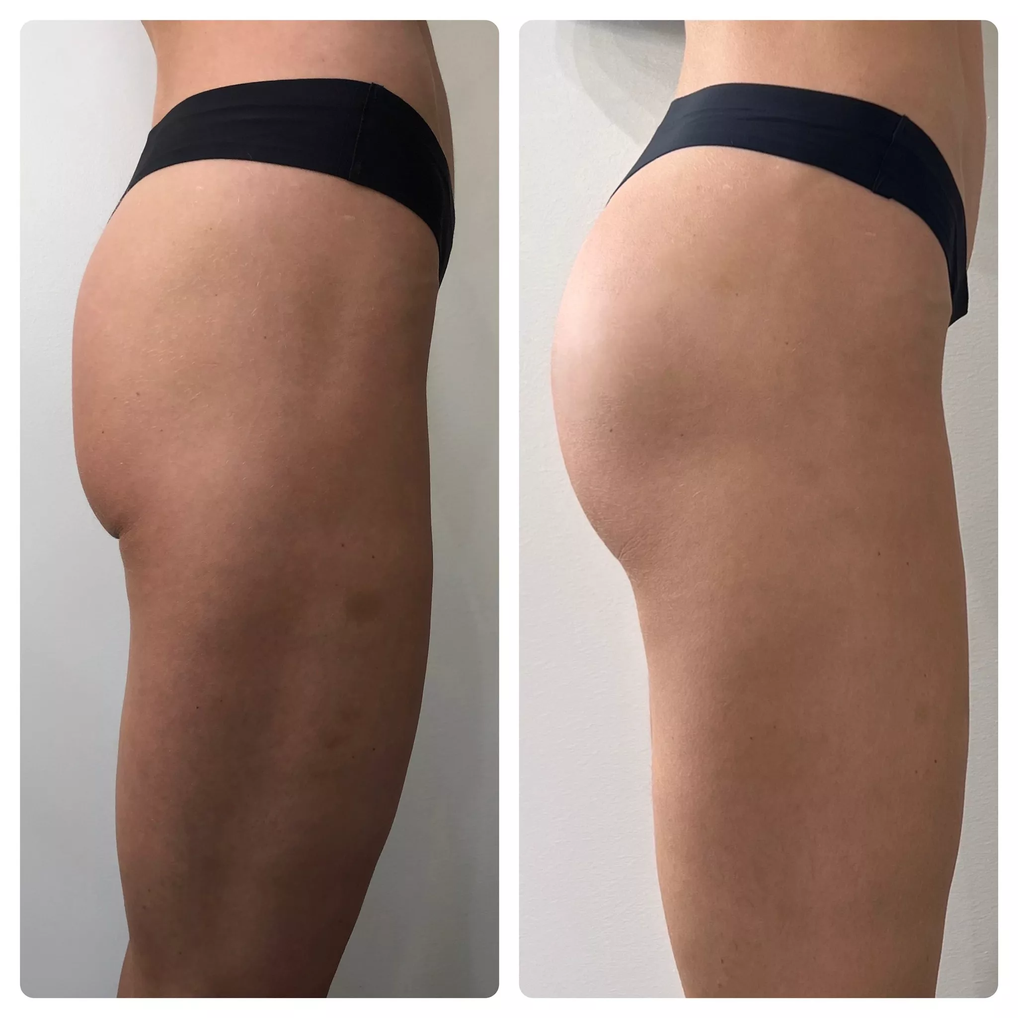 Glute lift before and after treatment