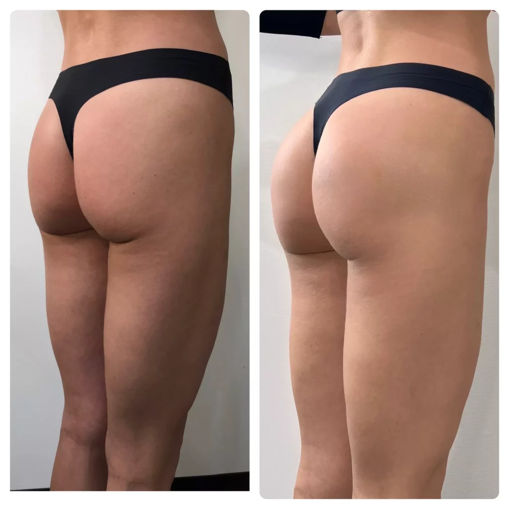 Before and after Non-Surgical BBL results