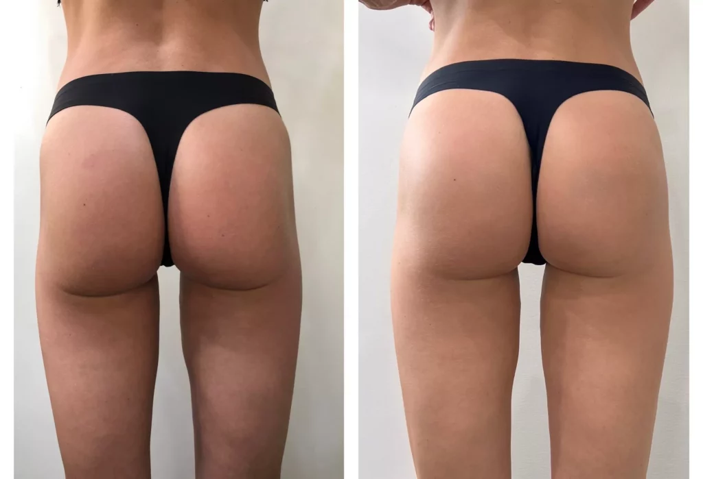 Non-surgical butt lift transformation before and after