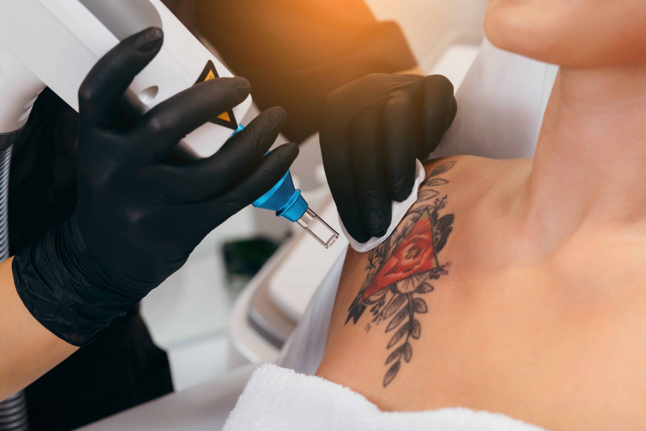 Q-Switch Laser Tattoo Removal in Salt Lake City by RO Aesthetics